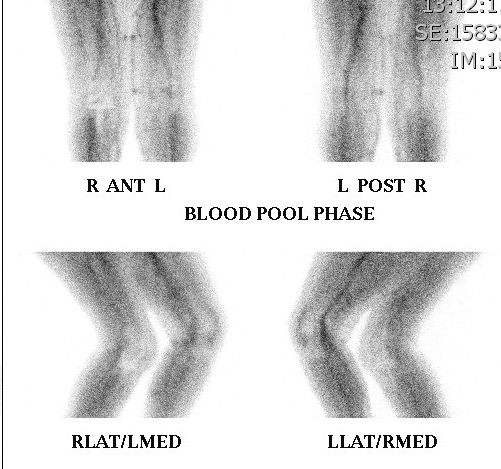Bone Scan Loose TKR Normal Blood Pool Phase